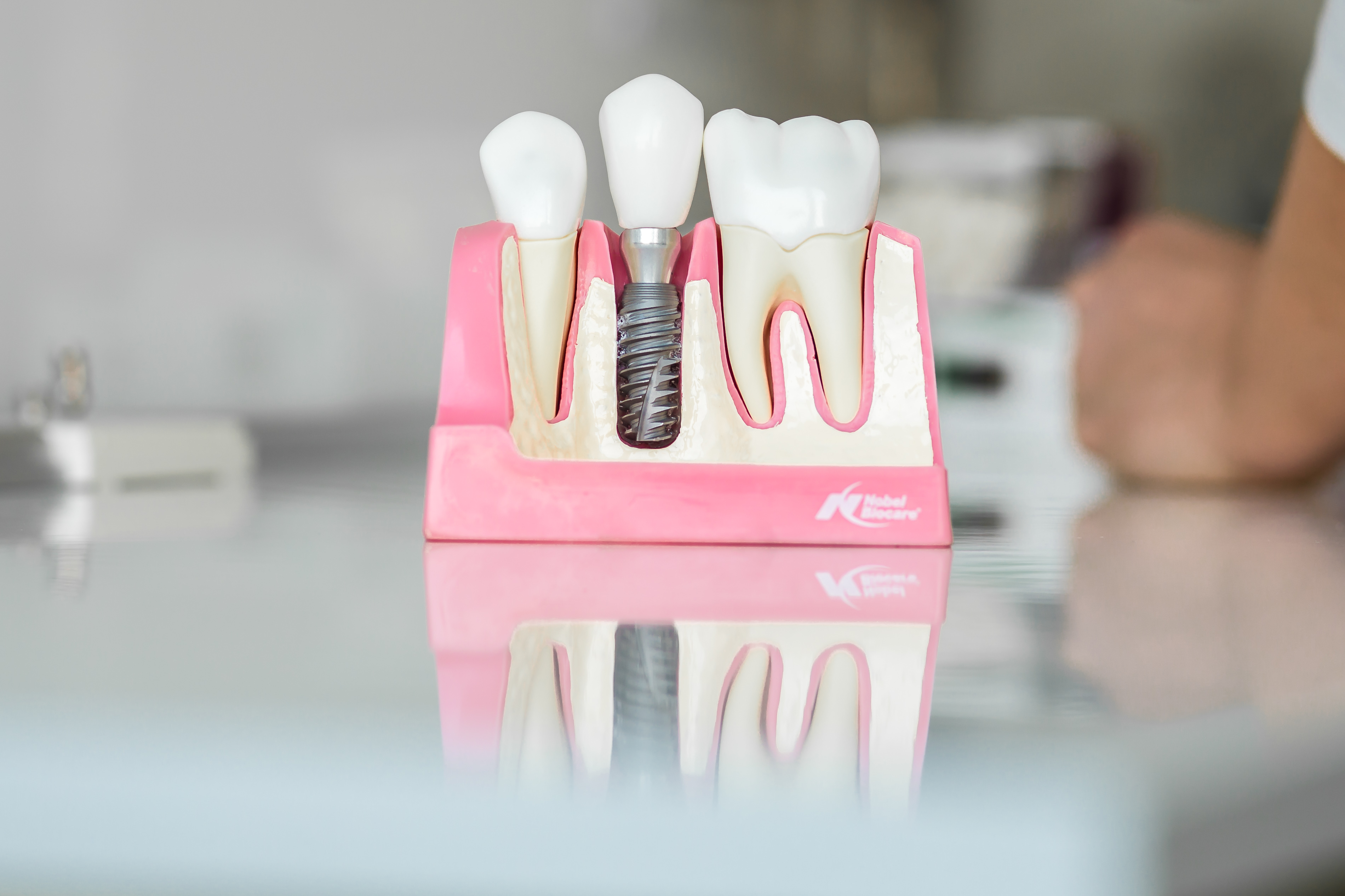 La guida completa per un impianto dentale: parte 1